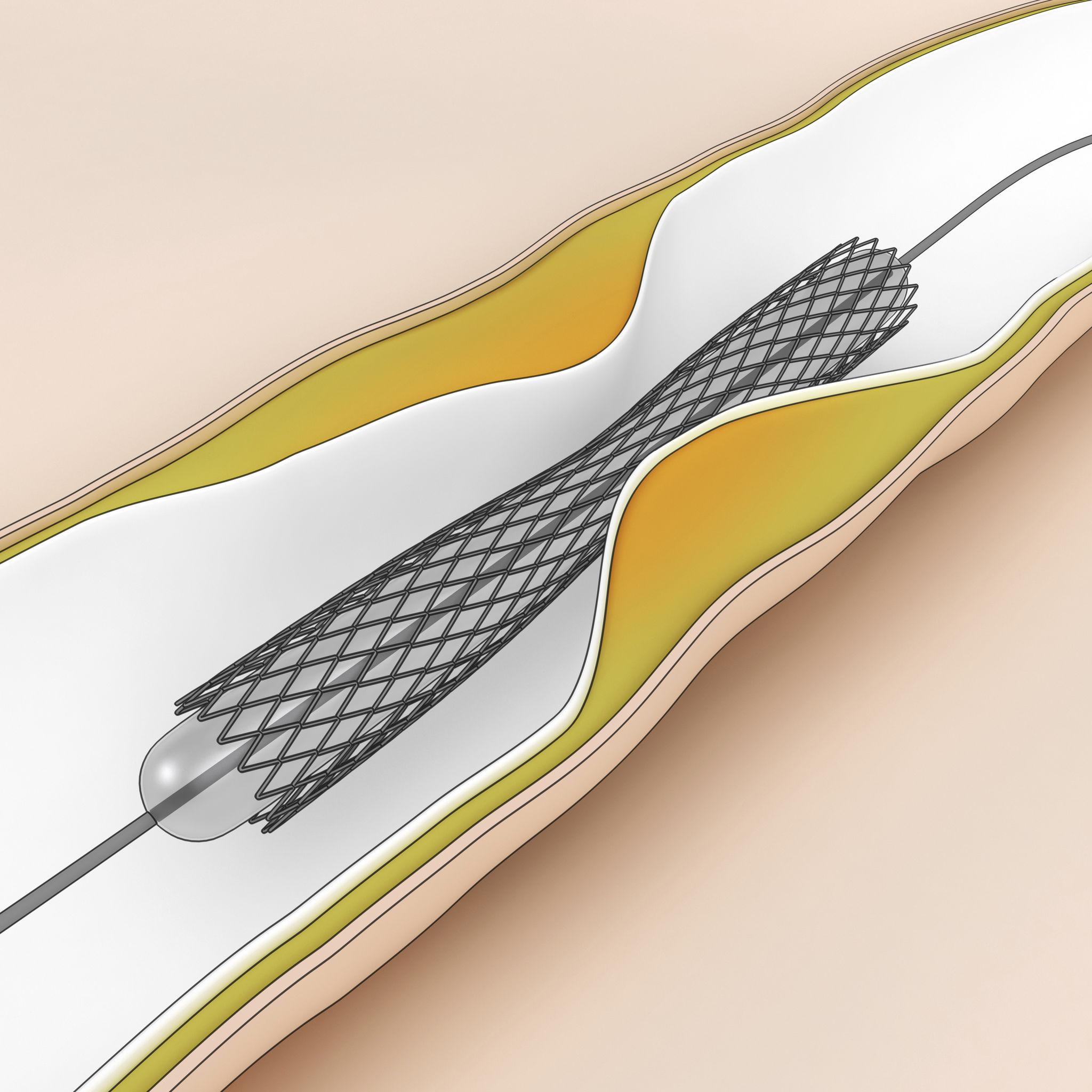 Coronary angioplasty and medical stent deployment in a blocked artery